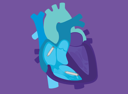 Pacemaker diagram