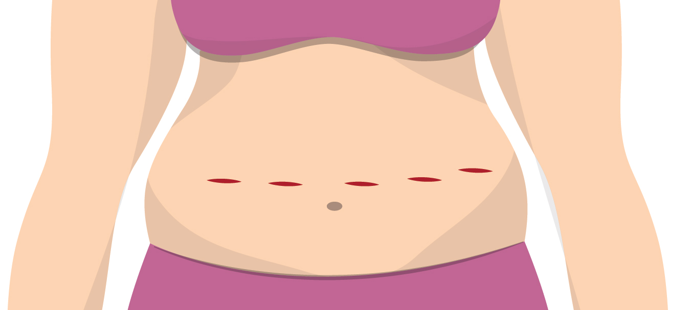 Diagram of marks on stomach from robotic surgery