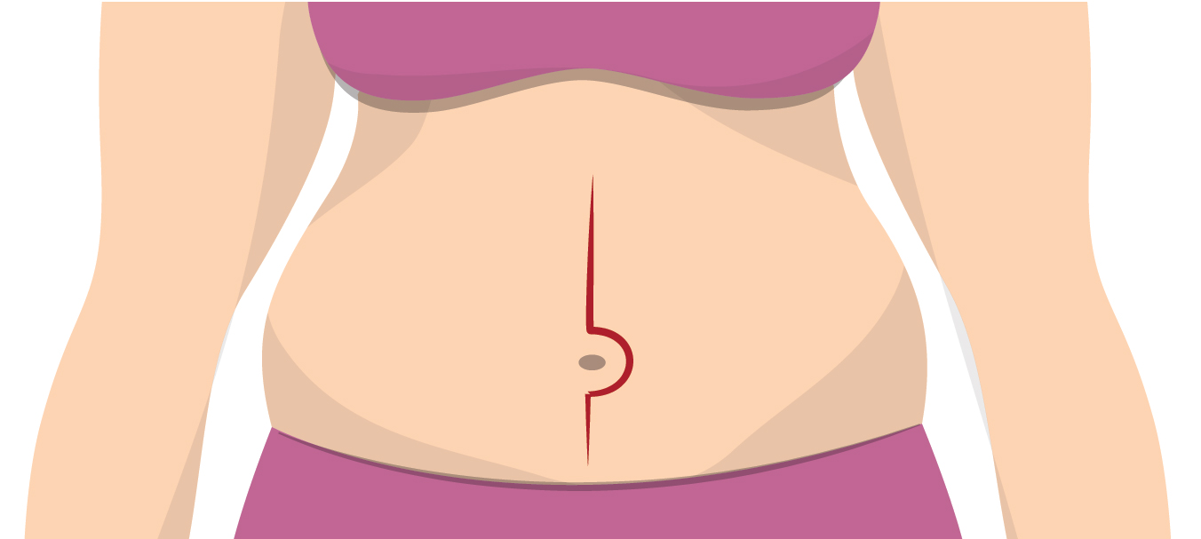 Diagram of marks on stomach from open surgery