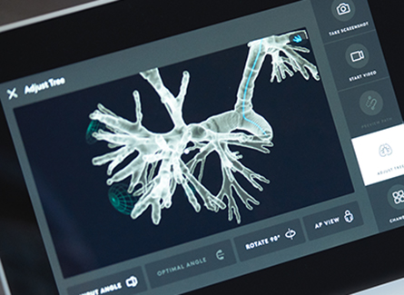 Ion Helps Chart Path to Earlier Lung Cancer Detection
