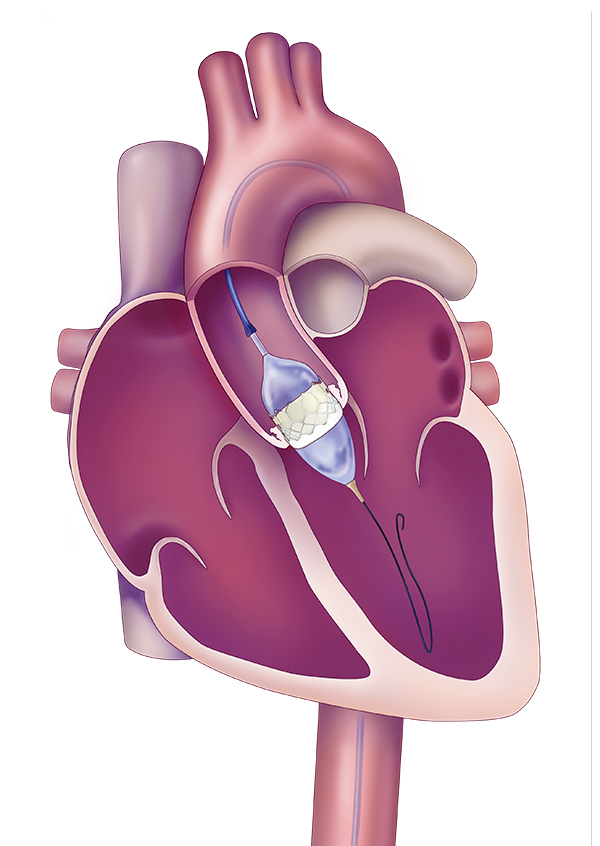TAVR is an innovative option for patients in need of heart valve replacements, but who have comorbidities that make them poor candidates for open-heart surgery. Photo: Edwards Lifesciences.