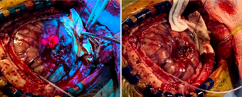 A comparison of a high-grade glioma shows how cancerous cells take on a luminescent pink color under 5-ALA florescent-guided resection (left) versus conventional surgery. Photo: NX Development Corp.