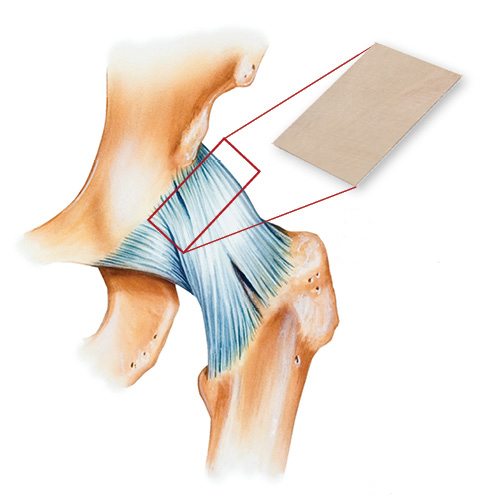 Allograft for reconstruction of capsular defect<br>Credit: MTS Biologics