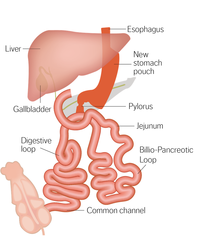 Diagram of the duodenal switch